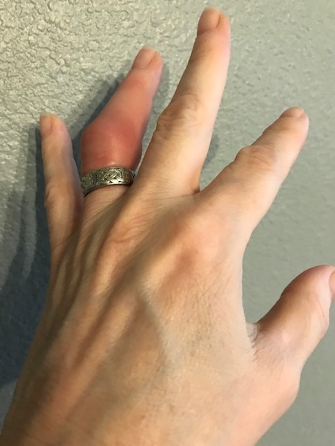 Swollen, red finger